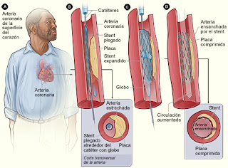 Angioplastia  colonaria |aterosclerosis|