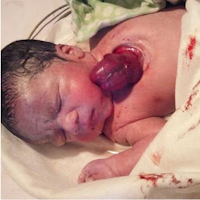Seorang bayi yang dilahirkan dengan jantungnya berdegup di luar dada mengejutkan ibu bapa dan doktor 