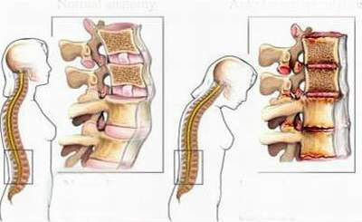 Tìm hiểu bệnh ung thư cột sống