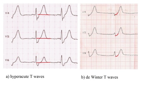 ECG Rhythms: De Winter's ST/T ECG changes in huge anterior ...