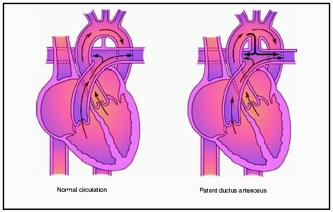 Nursing Care Plan: Nursing Care Plan for Patent Ductus Arteriosus