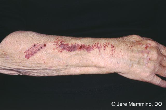 Purpura on arms. Source: American Osteopathic College of Dermatology. Photo credit:  Jere Mammino, OD.