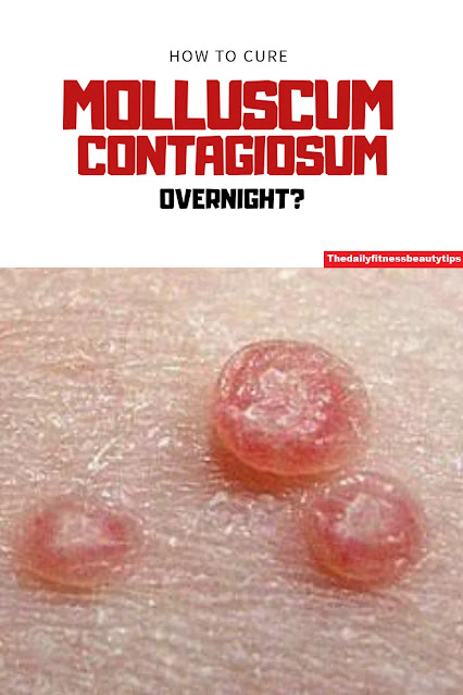 molluscum bumps treatment