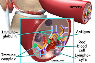 Definisi Dan Etiologi Penyakit Systemic Lupus Erythematosus (SLE) 