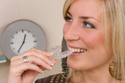 Phân tích nên ngậm máng tẩy trắng răng trong bao lâu  1