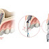 Giải đáp: Cấy ghép implant có an toàn không