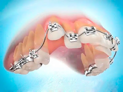 Đặc điểm của niềng răng không nhổ răng
