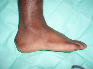 FOOT AND ANKLE PROBLEMS: HAGLUND SYNDROME