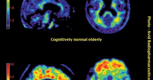 Plak Alzheimer Dapat Mengganggu Jaringan Otak