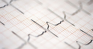 Idioventricular Rhythm Meaning, Rate, ECG, Causes, Treatment