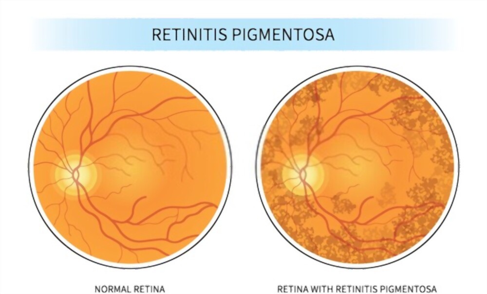 Difference between a normal retina vs a retina of someone who has RP