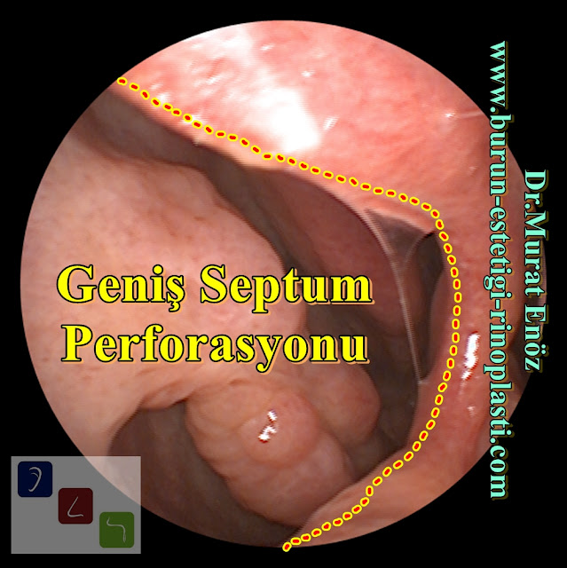 Septum perforasyonu tanımı - Septum perforasyonu  nedenleri - Septum perforasyonu belirtileri - Septum perforasyonu tedavisi - Açık teknik septum perforasyonu ameliyatı - Açık teknik septum perforasyonu onarımı - Burun duvarında delik