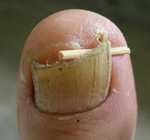 Ingrown toenail home remedies.