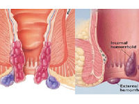 Obat Alami Wasir Stadium 4