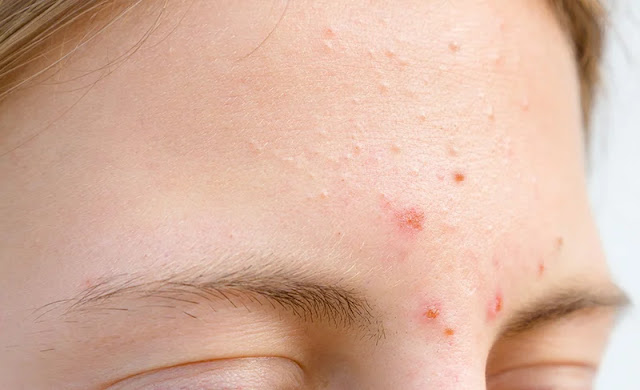 catch-disease-at-each-acne-location-to-find-a-treatment-solution-to-return-smooth-and-bright-skin