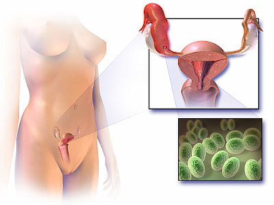 श्वेत प्रदर (Leucorrhoea)