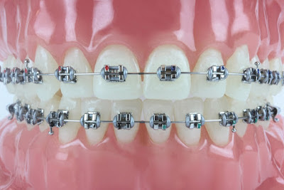  Niềng răng móm nhẹ có hiệu quả không?