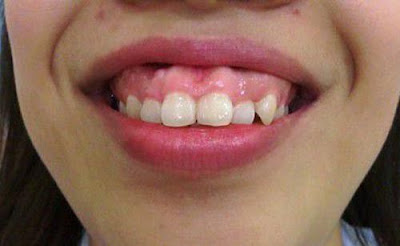 Răng hô là như thế nào và chữa được không?