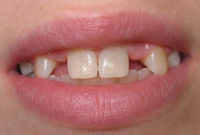 Làm cầu răng cửa có hiệu quả bằng trồng răng implant không?-1
