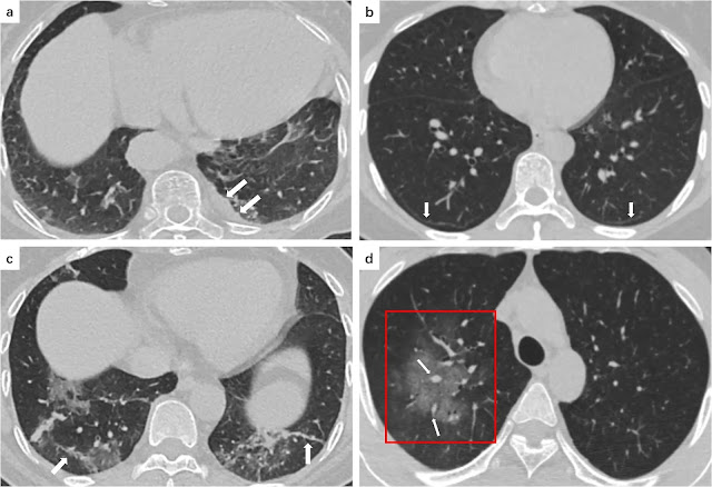 Gambar 4 : a. Pasien COVID-19 wanita berusia 80 tahun yang mengalami demam selama 7 hari. CT scan menunjukkan penebalan pleura kiri (panah putih). b. Seorang pasien COVID-19 wanita berusia 43 tahun yang mengalami demam dan menggigil selama 5 hari. CT scan menunjukkan garis subpleural (panah putih) di lobus bawah bilateral. c. Seorang pasien COVID-19 wanita berusia 66 tahun dengan gejala batuk dan mialgia selama 7 hari. CT scan menunjukkan GGO bilateral dan garis-garis fibrosa (panah putih) di lobus kiri bawah. d. Seorang pasien COVID-19 laki-laki berusia 35 tahun yang mengalami demam dan sakit kepala selama 1 hari. CT scan menunjukkan area GGO yang luas (kotak merah) di lobus kanan atas dengan beberapa pembesaran vaskular kecil (panah putih)