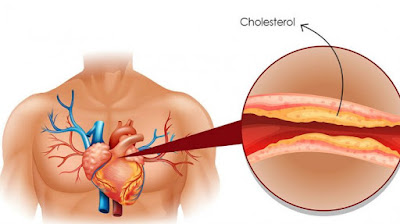Gejala dan Cara Alami Menurunkan Kolesterol