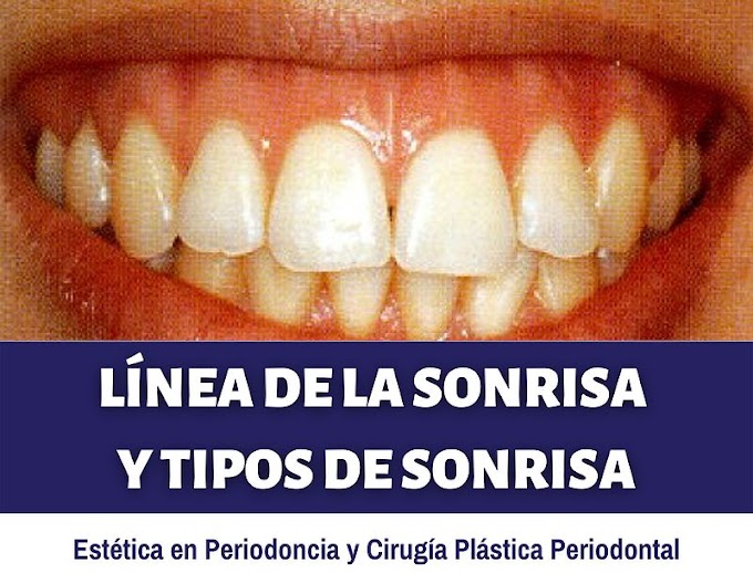 Línea de la Sonrisa y Tipos de Sonrisa