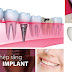 Răng Implant có gây hại cho cơ thể ?