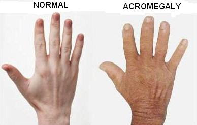 Acromegaly Definition : What Is Acromegaly