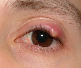 Red And Swollen Eyelids
