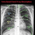 الاشعة العادية على الصدر   chest  x-  ray