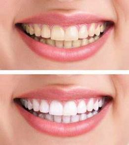 teeth-whitening-before-after