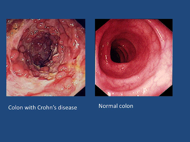 WHAT IS PILES? DIFFERENCE BETWEEN PILES AND HAEMORRHOIDS?  TYPES, HOW DO PILES START? CAUSES.SYMPTOMS, DIAGNOSIS . TREATMENT