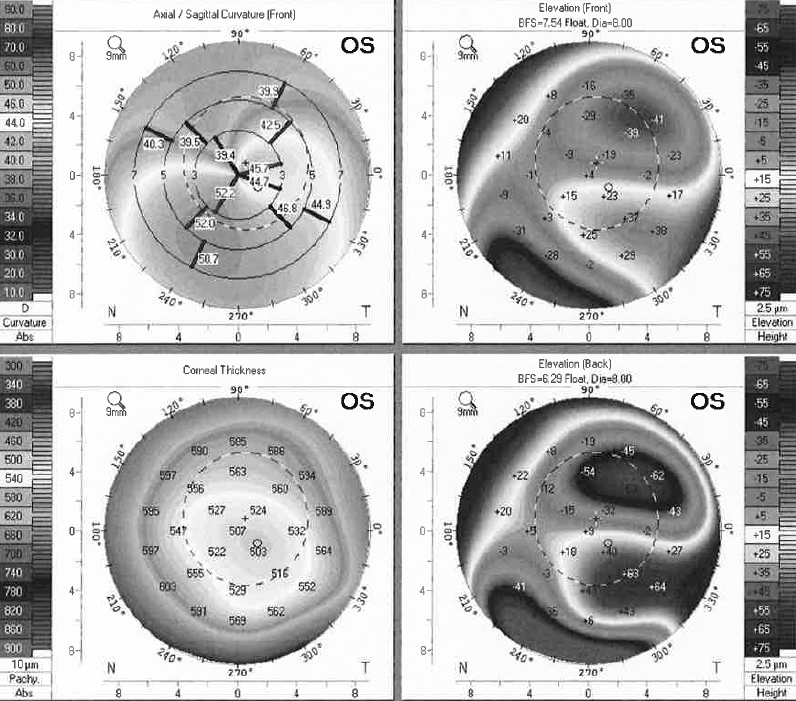 Keratoconus Topography Pentacam "A Two-Decade Journey with Keratoconus" (Becky Wilder)