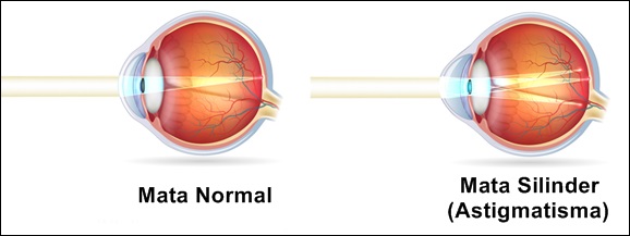 2 Cara Praktis Menyembuhkan Mata Silinder (Astigmatisma) Secara Alami Dan Cepat