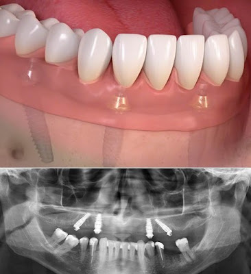 Trồng răng sứ nguyên hàm bằng cấy ghép implant-2
