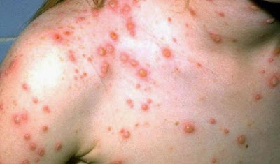 chicken pox pictures | chicken pox symptoms | what is chicken pox