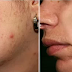 Remove skin pimples in simple 5 steps