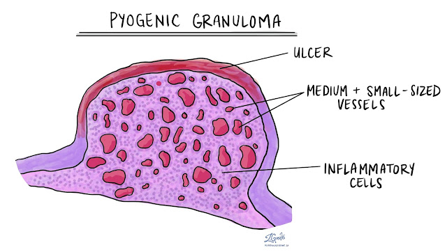 pyogenic granuloma hemangioma