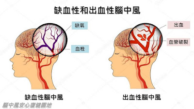 缺血性腦中風是因為腦血管堵塞所致，出血性腦中風則是因腦血管破裂出血導致