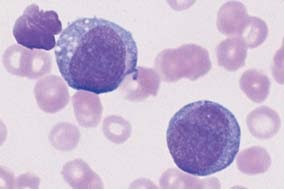 In monoblastic leukemia M5 a