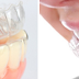  Những ưu điểm của invisalign