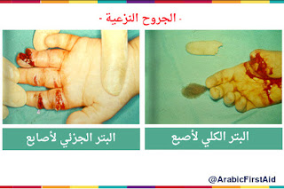 إسعاف الجروح النزعية (البتر) و الاحتفاط بالجزء المنزوع أو المبتور