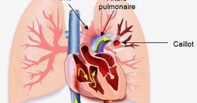 Thrombose artérielle physiopathologie