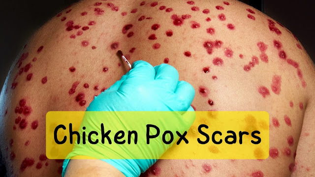 remove chicken pox scars