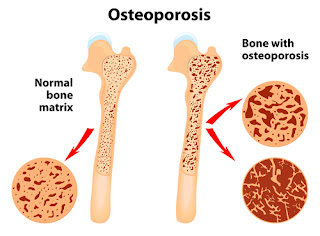 blood test for osteoporosis osteoporosis scan osteoporosis treatment injection osteoporosis treatment options shot for osteoporosis side effects of stopping forteo