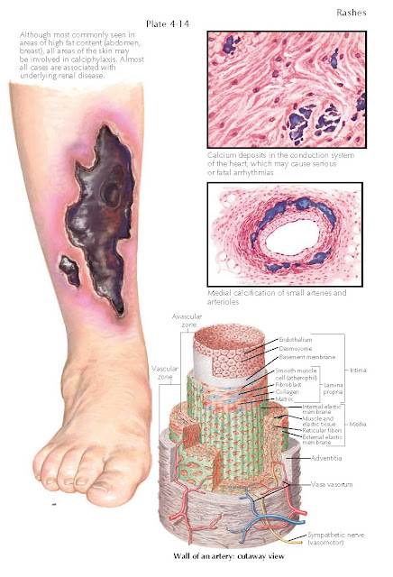 CALCIPHYLAXIS