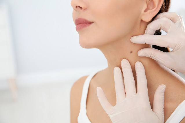 Lichen Planus Treatment-- Restore Skin Health