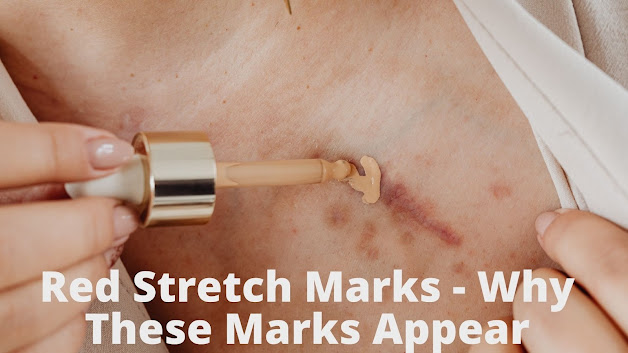 red stretch marks