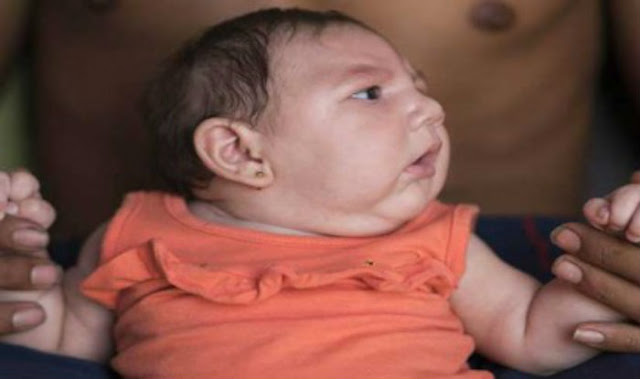 4 most common birth defects in India