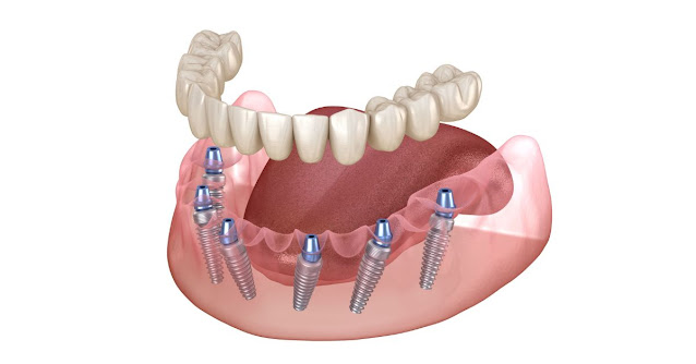 https://meiplus.com.sg/all-on-6-dental-implants-singapore/